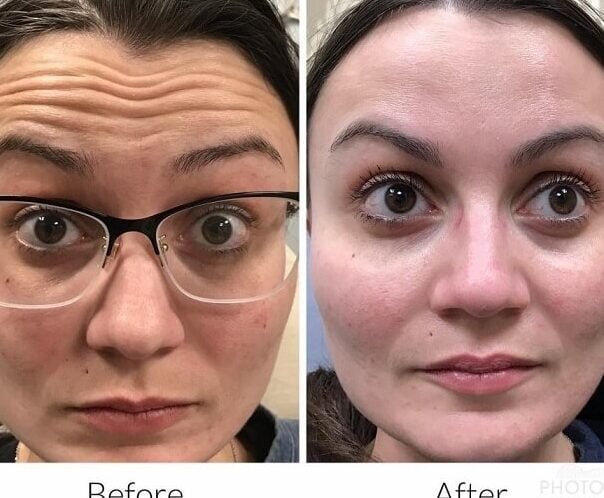 b elite spa botox revision y opiniones